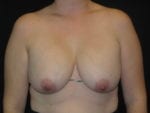 Breast Implant Revision - Case Case 7 - Before