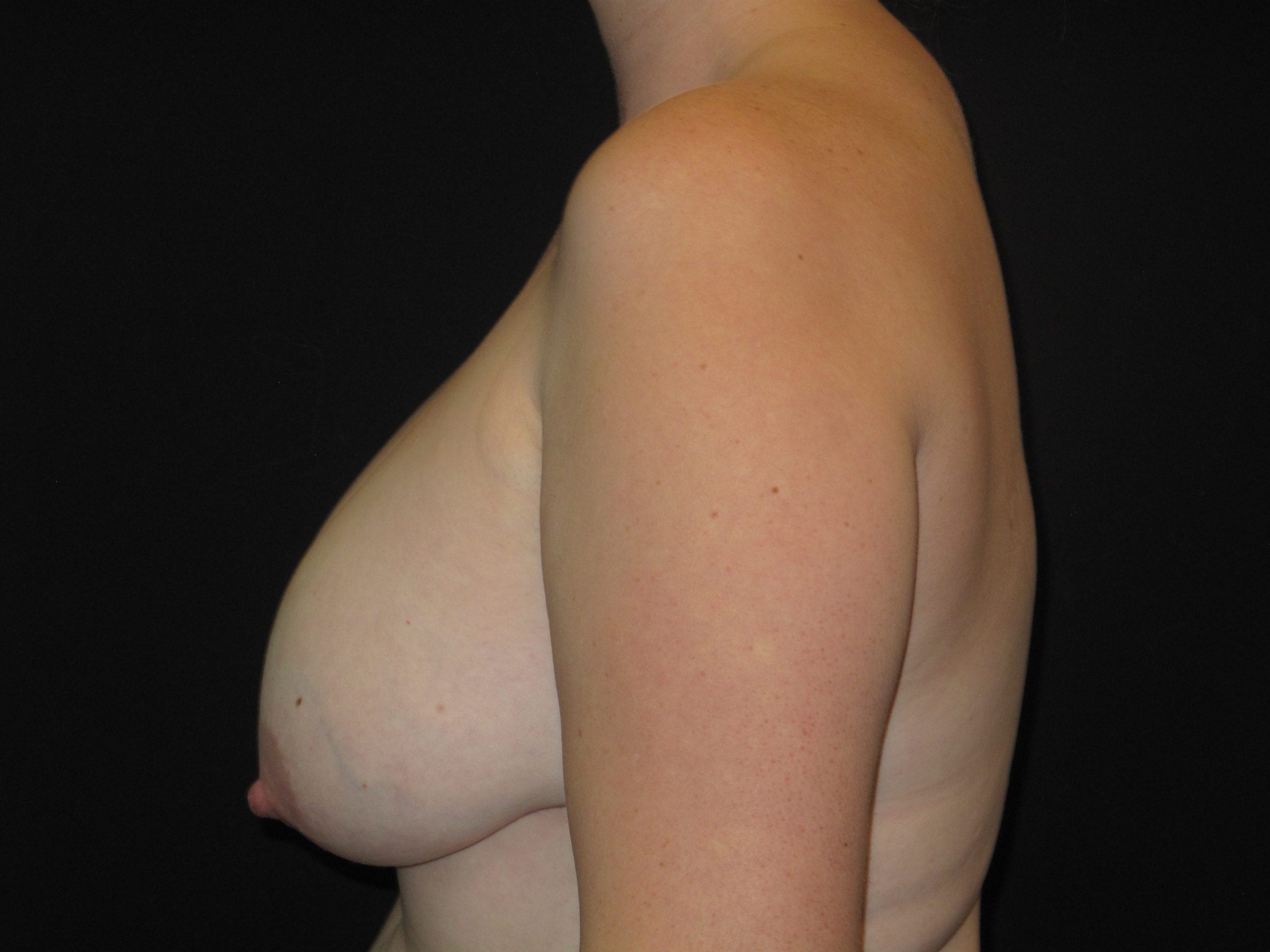 Breast Implant Revision Patient Photo - Case Case 7 - before view-2