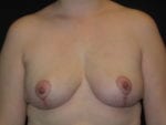 Breast Implant Revision - Case Case 7 - After