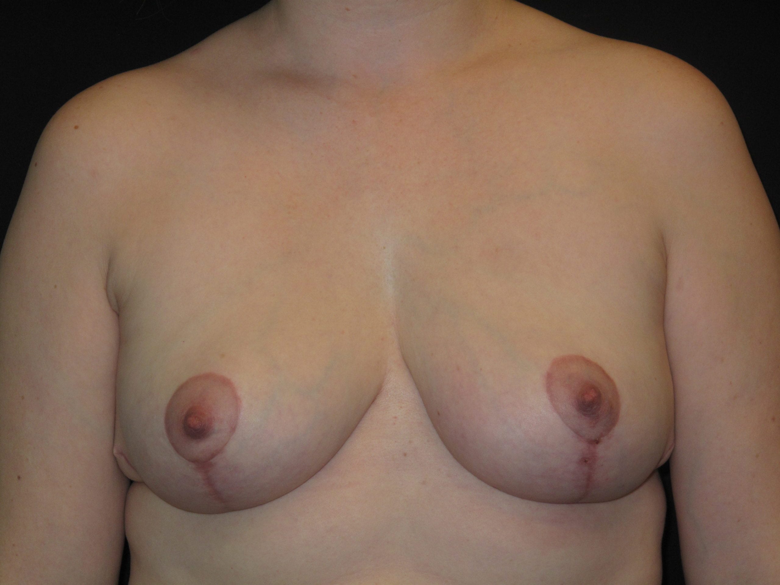 Breast Implant Revision Patient Photo - Case Case 7 - after view