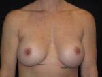 Breast Implant Revision - Case Case 8 - Before