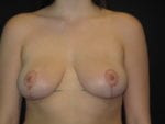 Breast Reduction - Case Case 2 - After