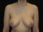 Breast Reduction - Case Case 3 - After