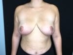 Breast Reduction - Case Case 6 - After
