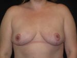 Breast Reduction - Case Case 5 - After