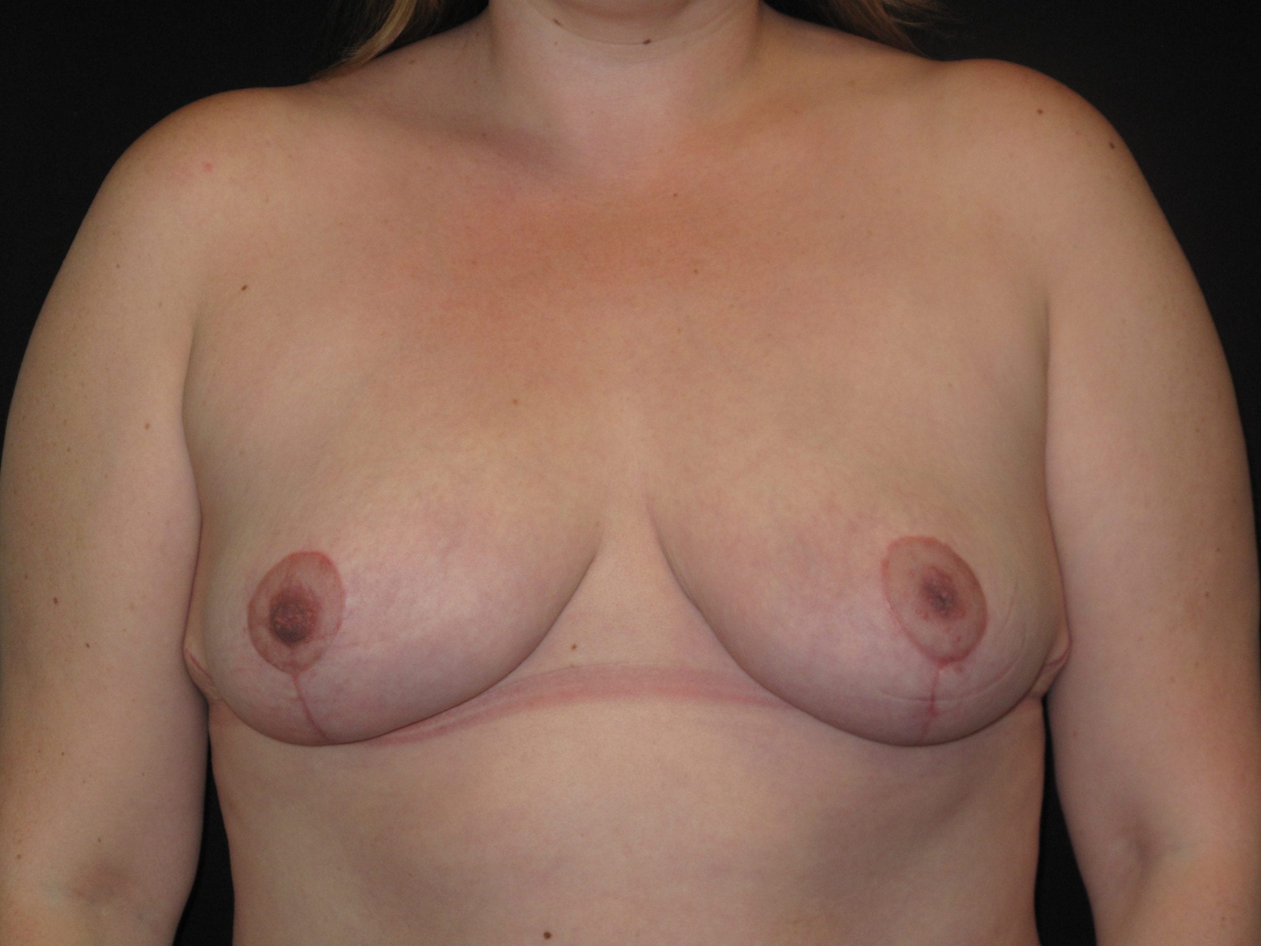 Breast Reduction Patient Photo - Case Case 5 - after view-0