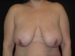 Breast Reduction - Case Case 5 - Before