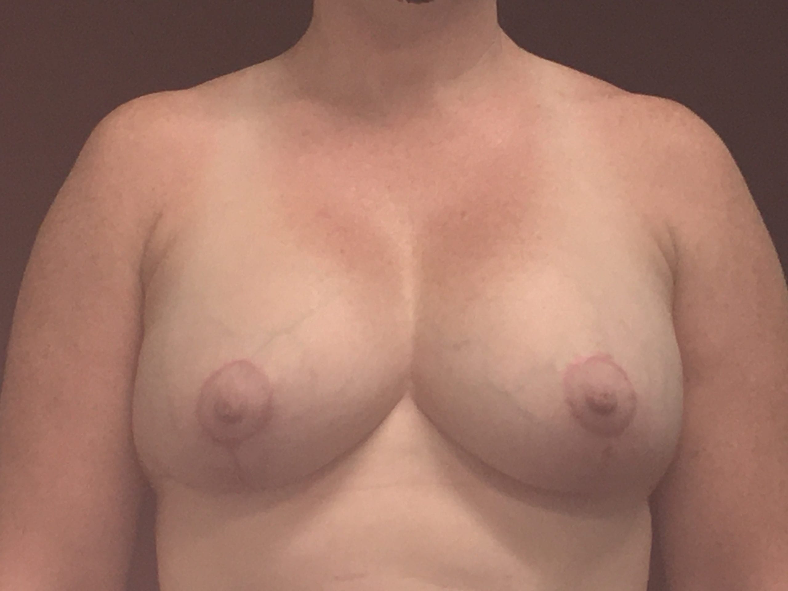 Breast Implant Revision Patient Photo - Case Case 9 - after view-0
