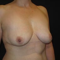 Explant Patient Photo - Case Case 6 - after view-1