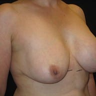 Explant Patient Photo - Case Case 6 - before view-1