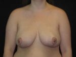 Breast Reduction - Case Case 9 - After