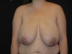 Breast Reduction - Case Case 9 - Before