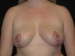 Breast Reduction - Case Case 10 - After