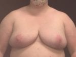 Breast Reduction - Case Case 11 - After