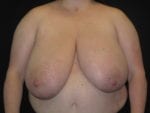 Breast Reduction - Case Case 11 - Before