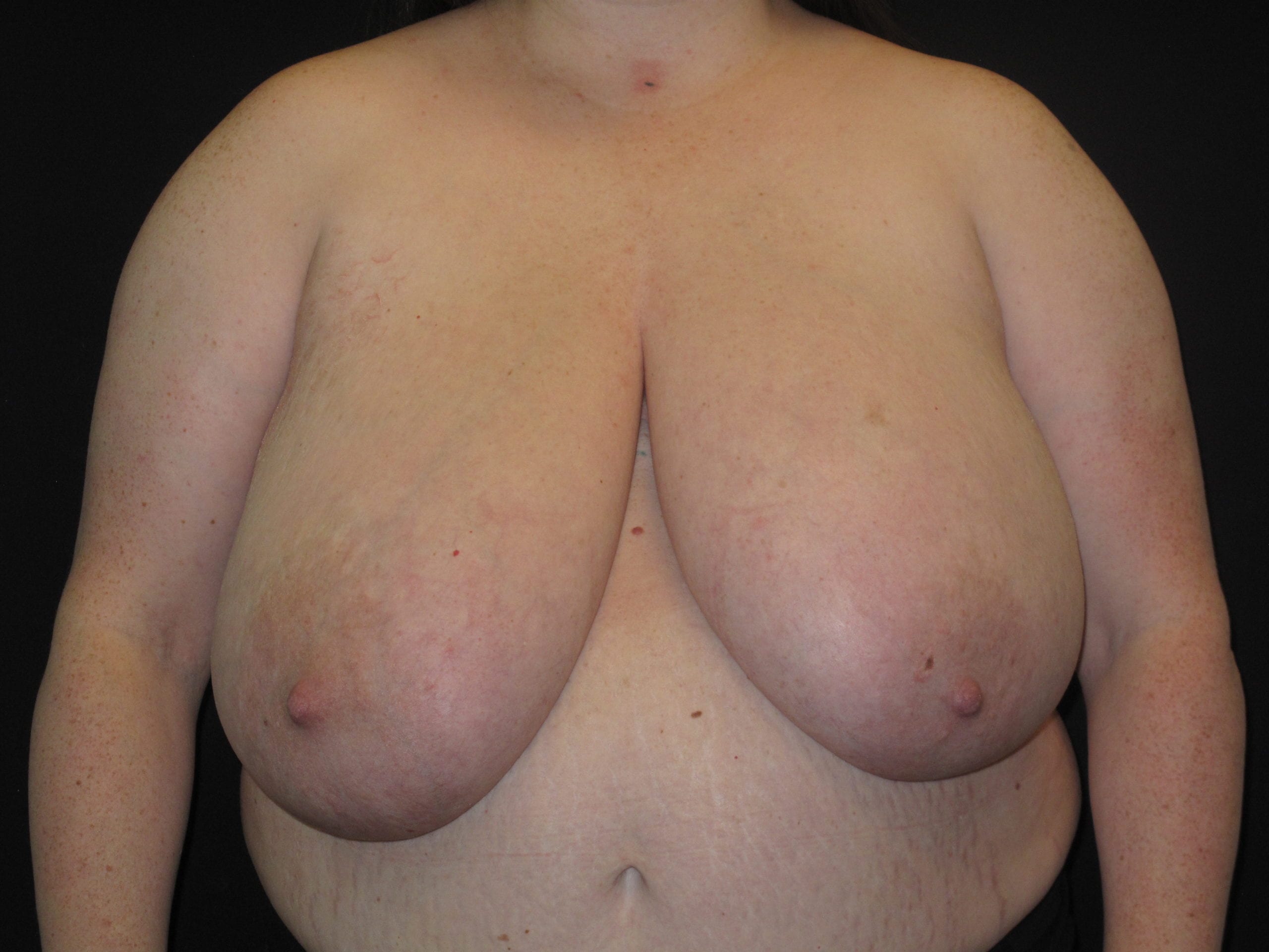Breast Reduction Patient Photo - Case Case 11 - before view-0