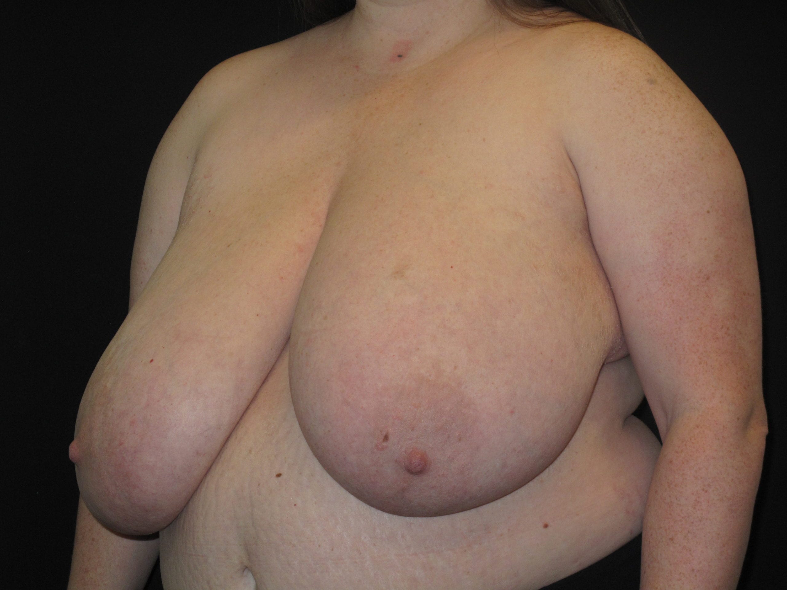Breast Reduction Patient Photo - Case Case 11 - before view-1