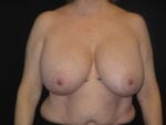 Breast Reduction - Case Case 13 - Before