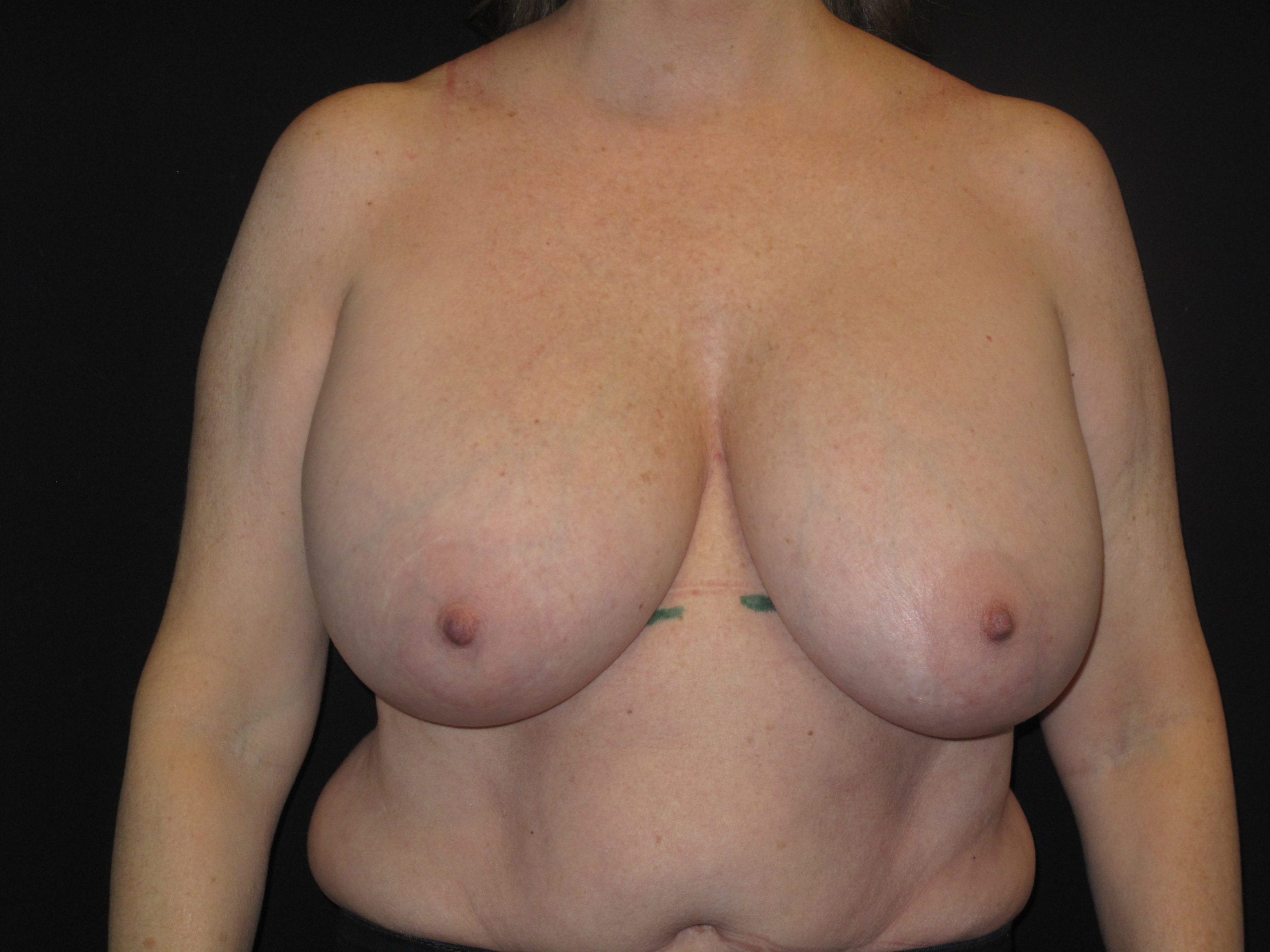 Breast Reduction Patient Photo - Case Case 13 - before view-