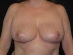 Breast Reduction - Case Case 13 - After