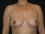 Breast Reduction - Case Case 14 - After