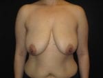 Breast Reduction - Case Case 14 - Before