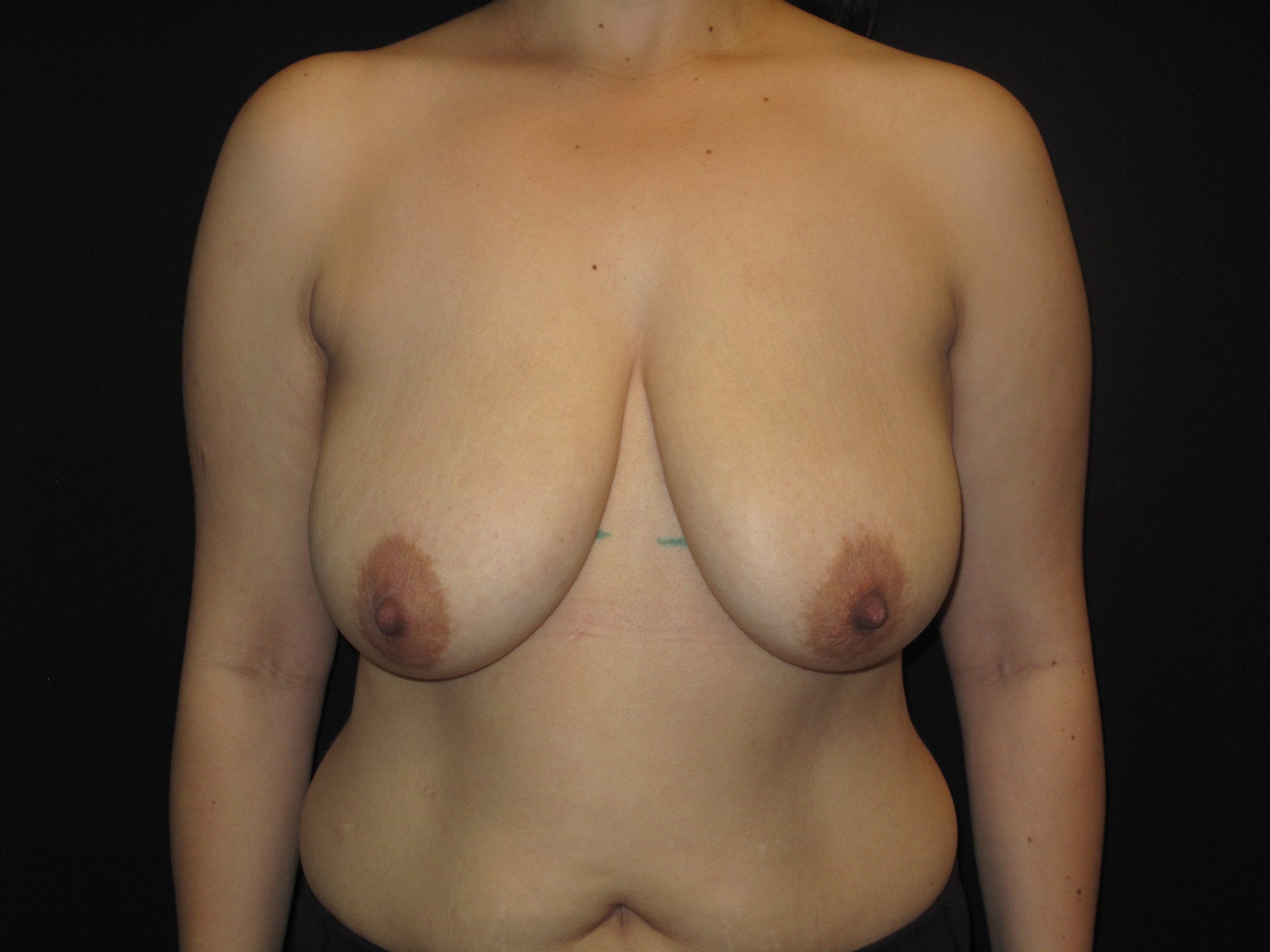 Breast Reduction Patient Photo - Case Case 14 - before view-