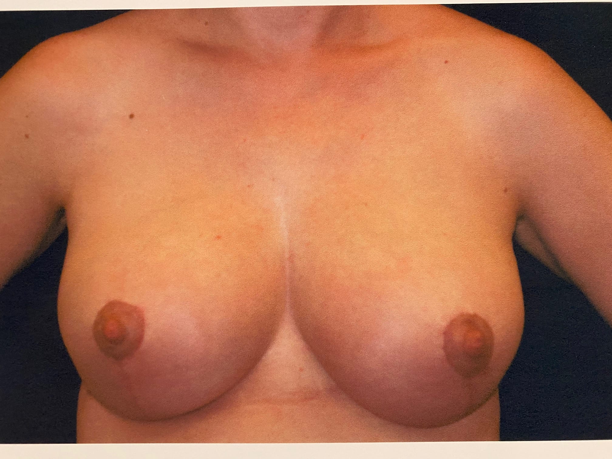 Breast Reduction Patient Photo - Case Case 15 - after view