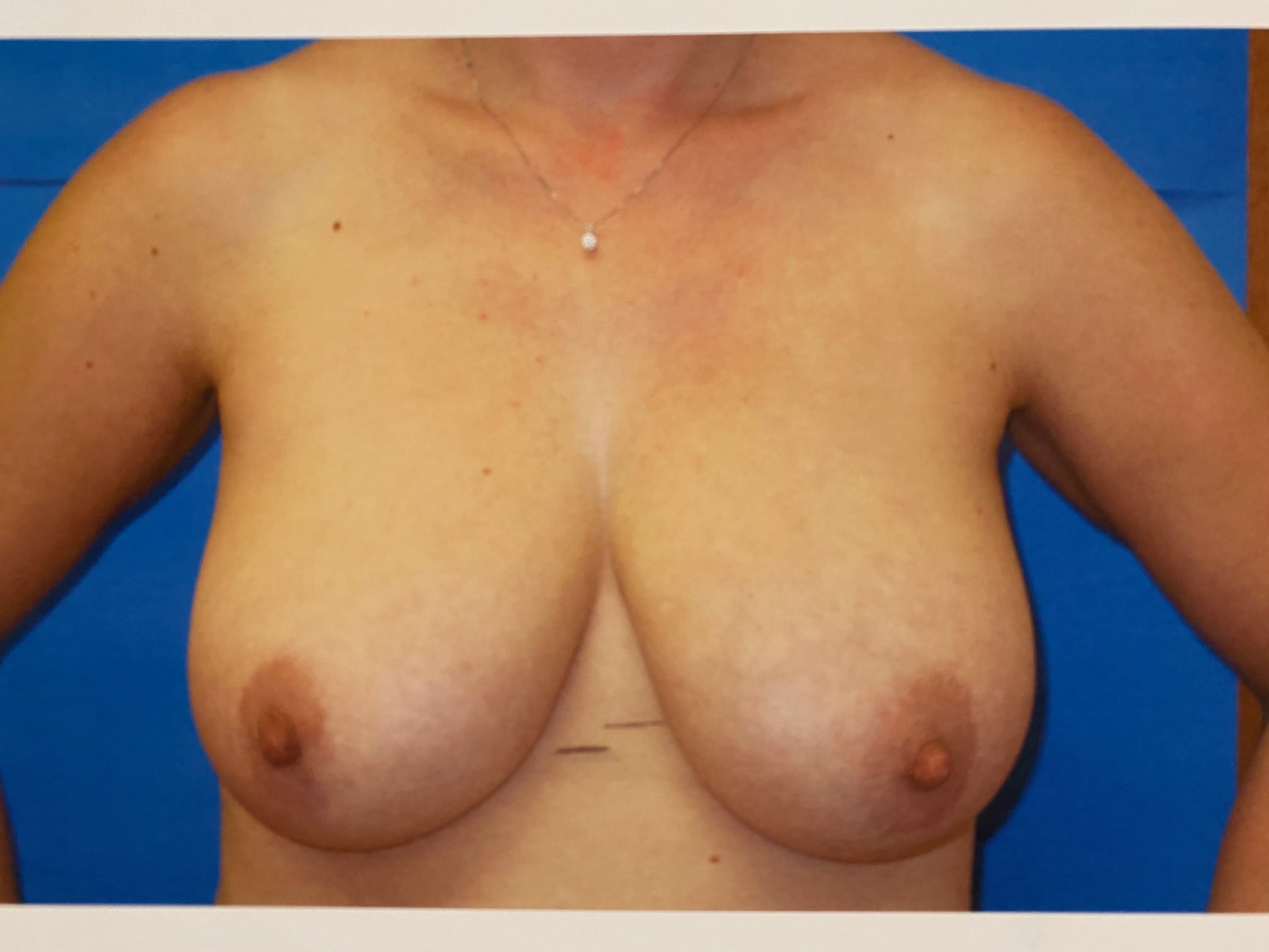 Breast Reduction Patient Photo - Case Case 15 - before view-