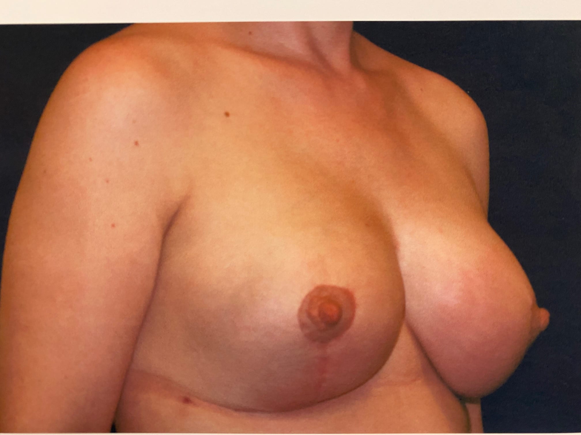 Breast Reduction Patient Photo - Case Case 15 - after view-1