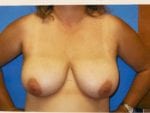 Breast Reduction - Case Case 16 - Before