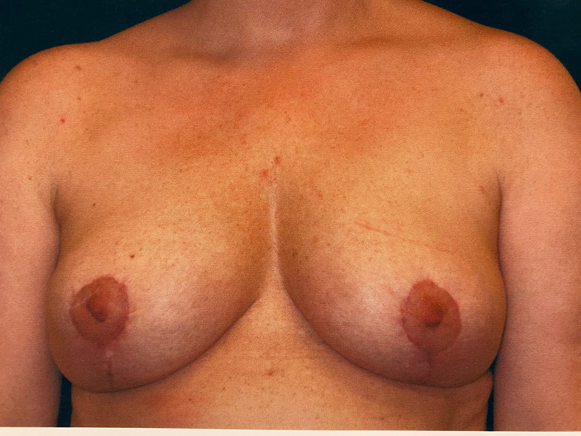 Breast Reduction Patient Photo - Case Case 17 - after view-0