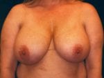 Breast Reduction - Case Case 17 - Before