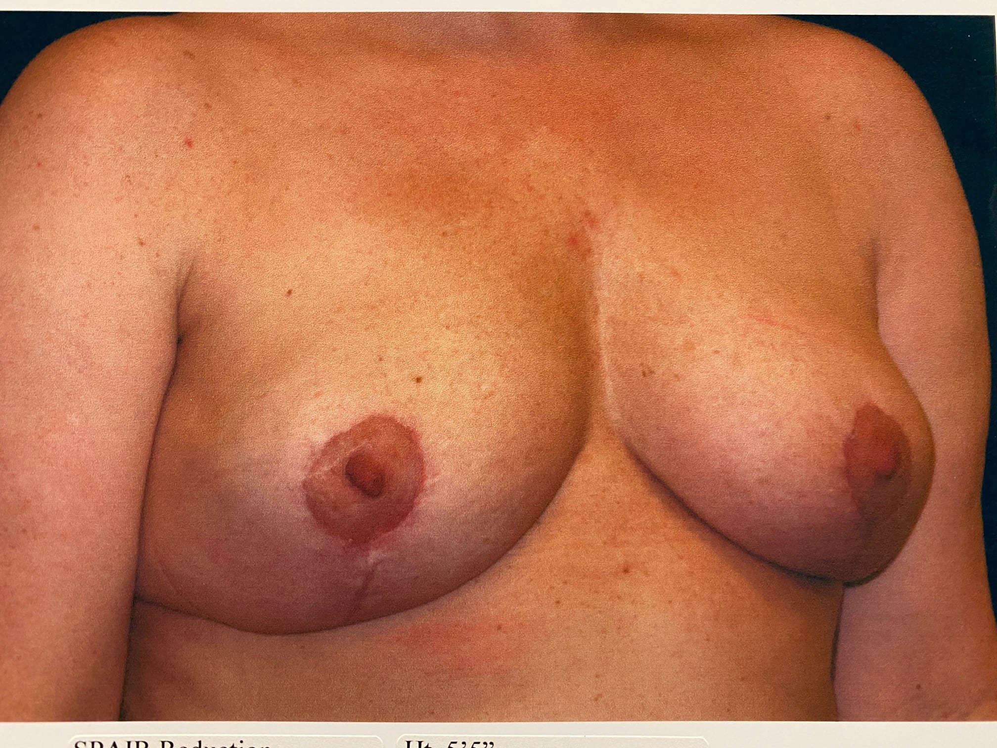 Breast Reduction Patient Photo - Case Case 17 - after view-1