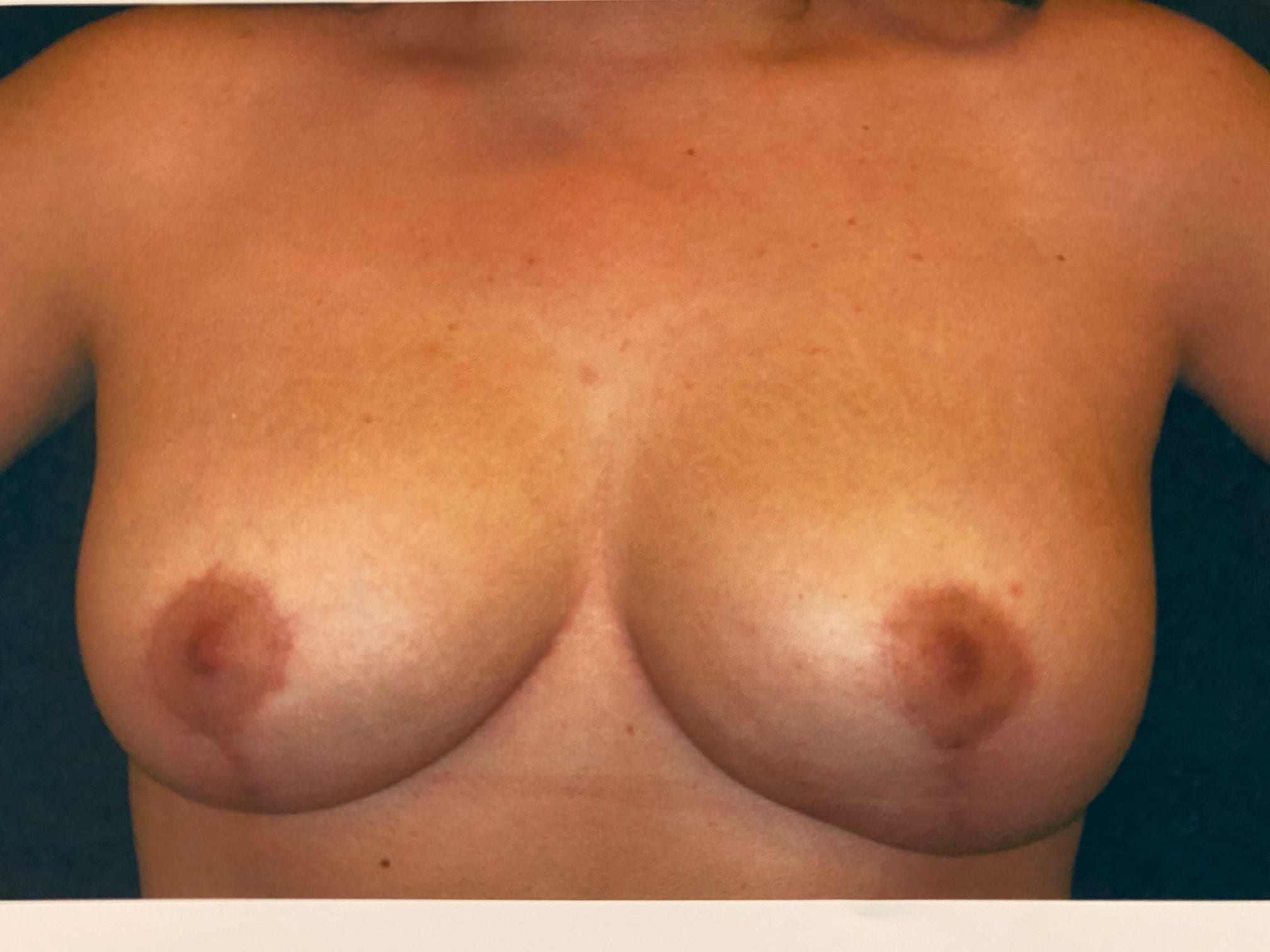Breast Reduction Patient Photo - Case Case 18 - after view