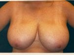Breast Reduction - Case Case 18 - Before