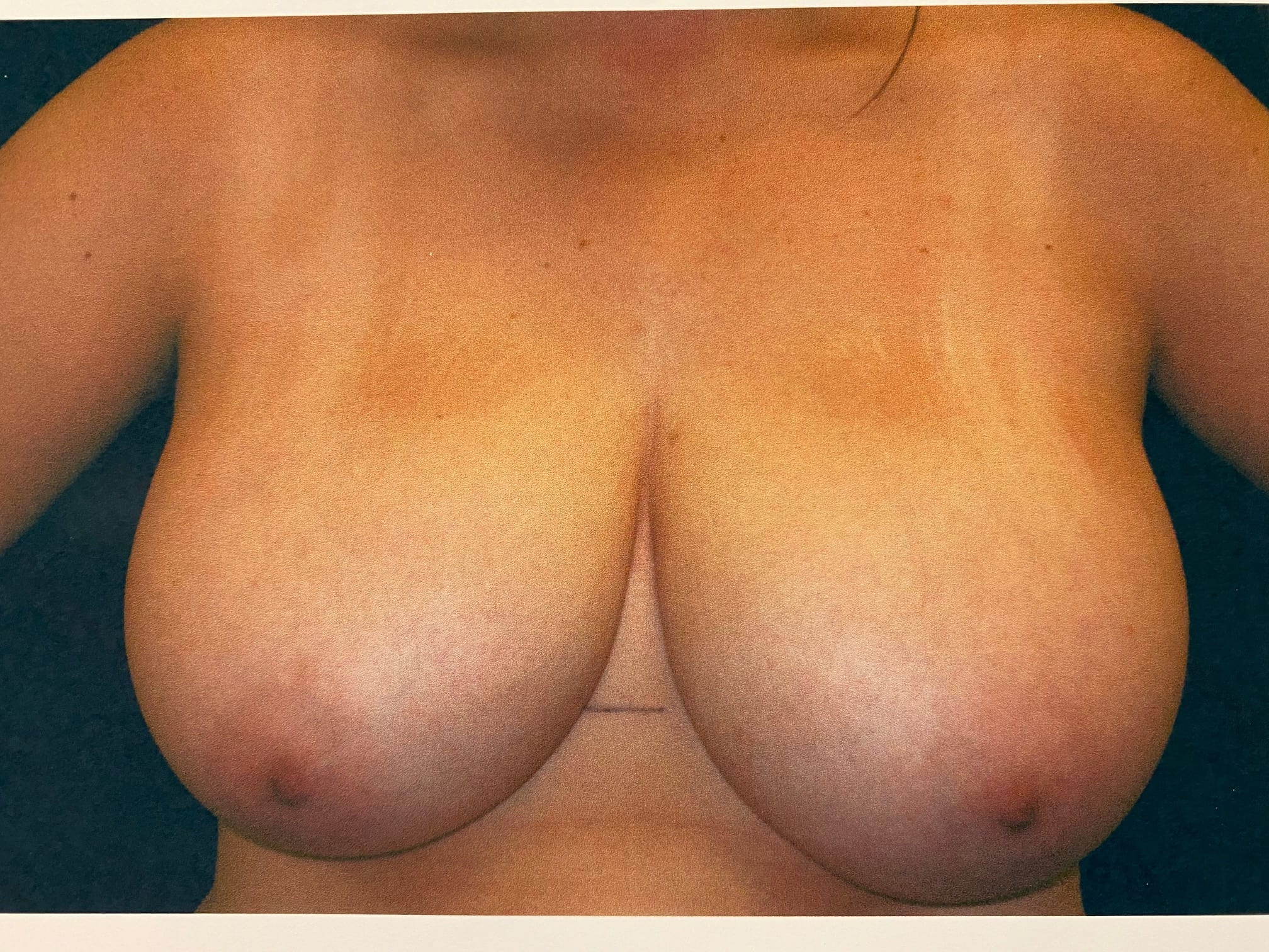 Breast Reduction Patient Photo - Case Case 18 - before view-0