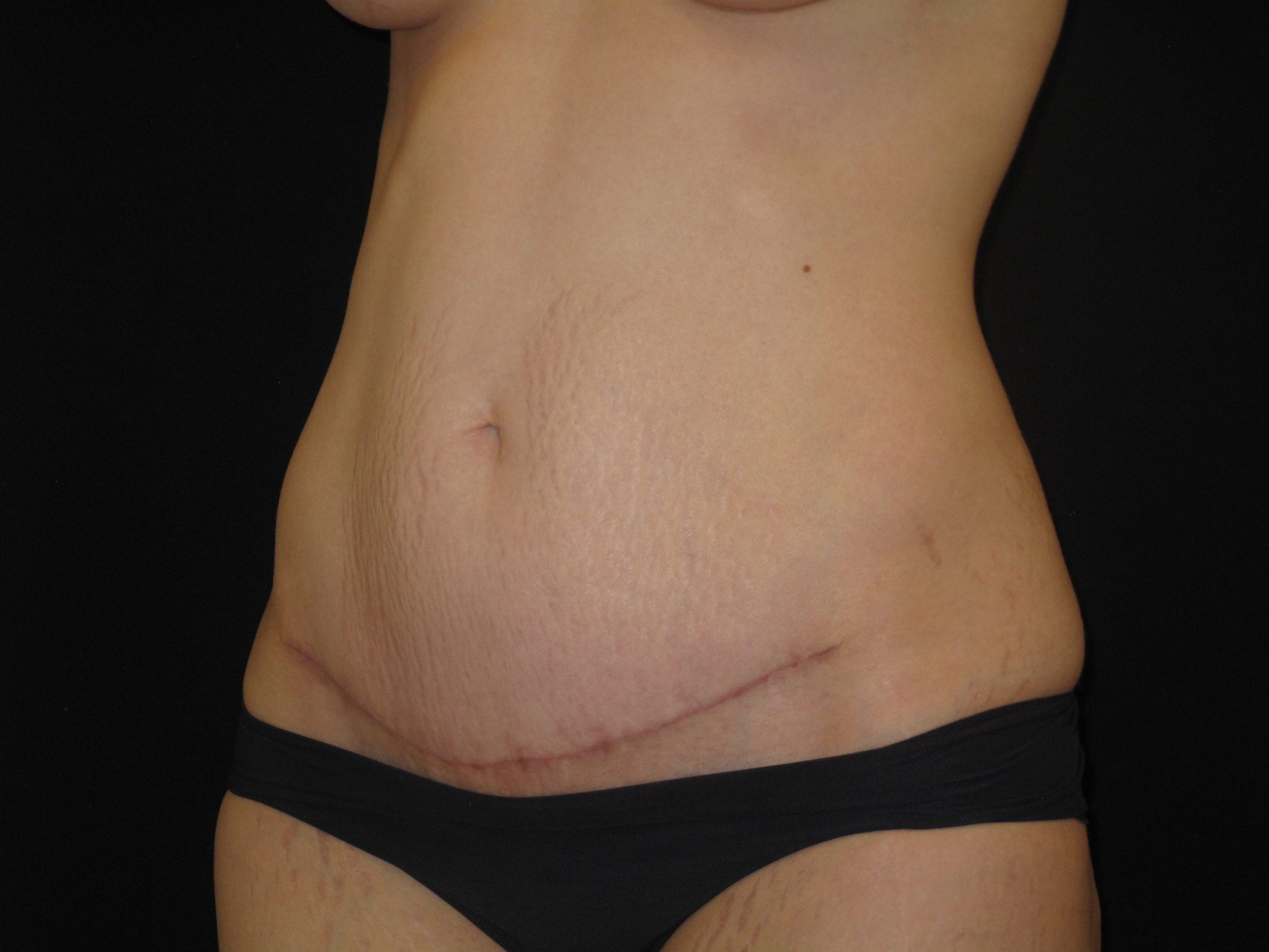 Mini Tummy Tuck Patient Photo - Case Case 3 - after view-1