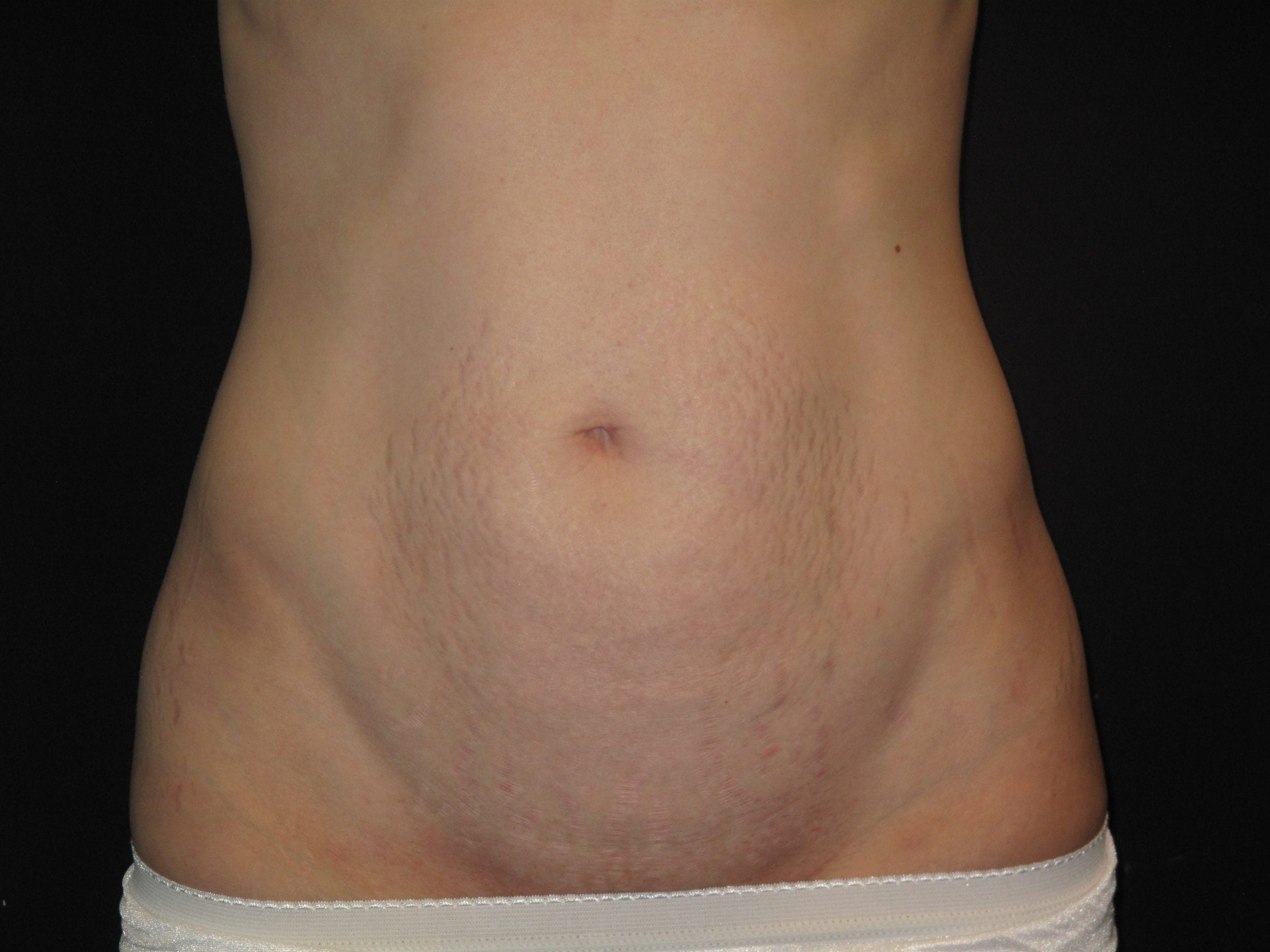 Mini Tummy Tuck Patient Photo - Case Case 3 - before view-0
