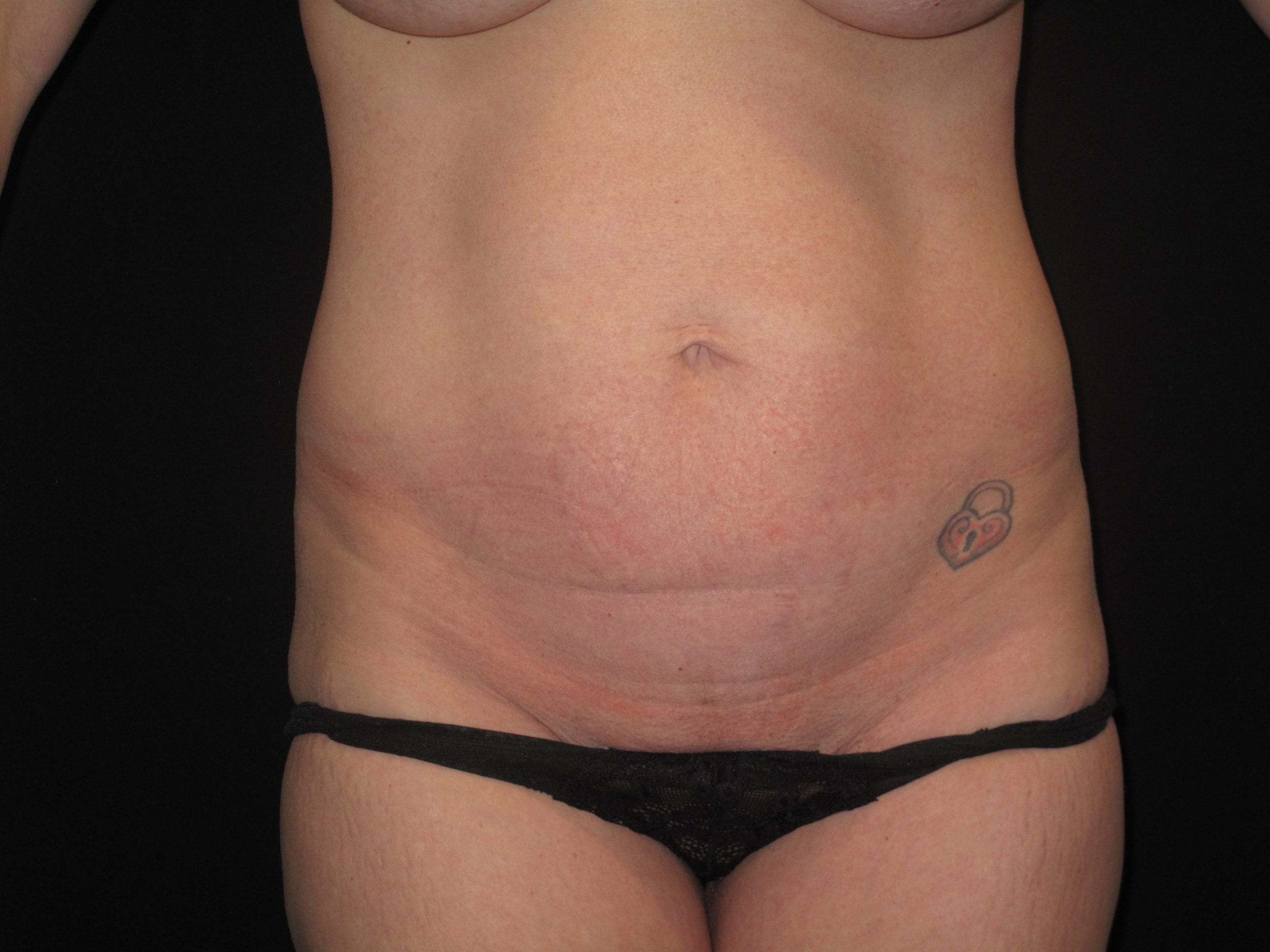 Mini Tummy Tuck Patient Photo - Case Case 4 - before view-0