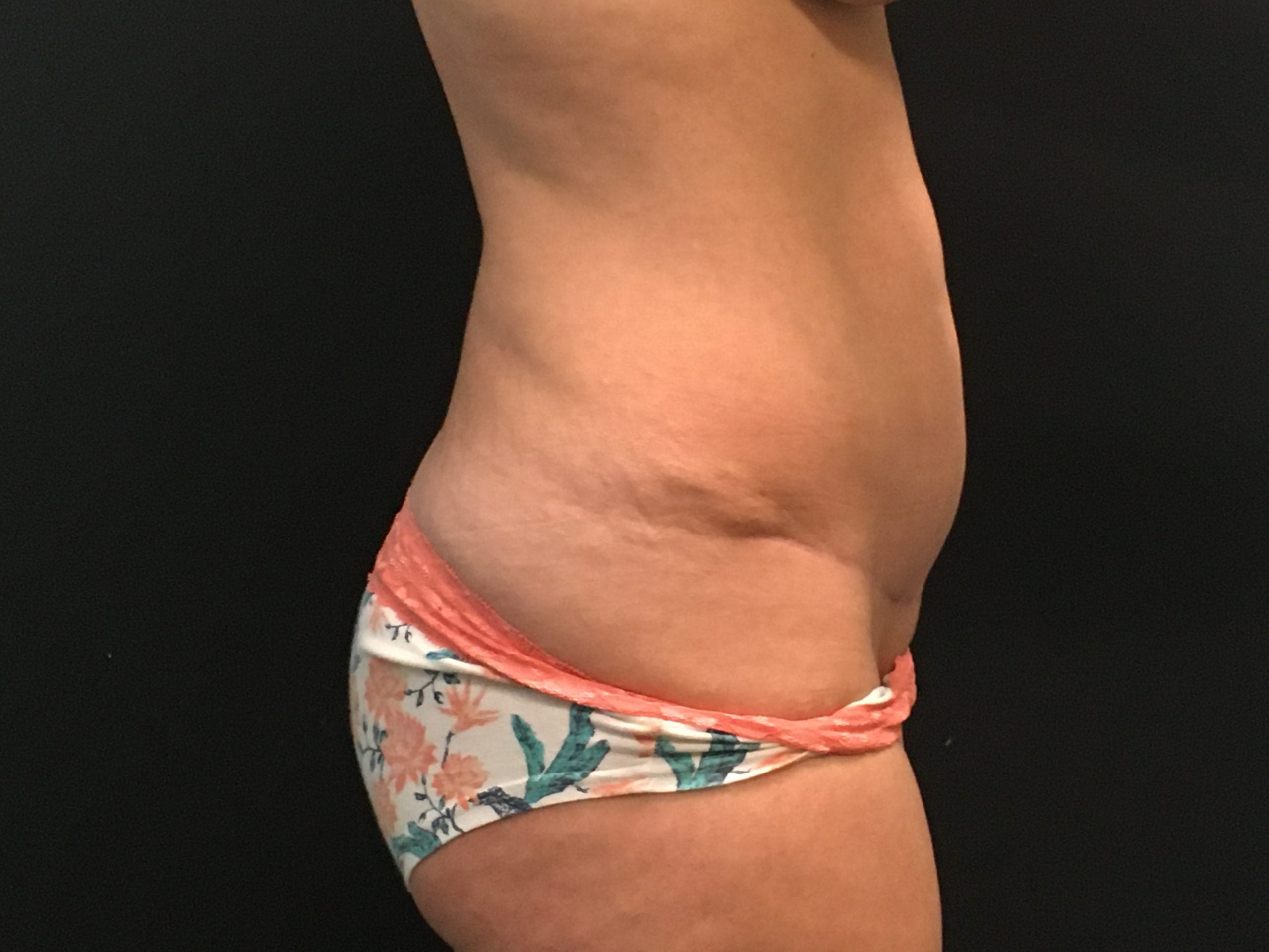 Mini Tummy Tuck Patient Photo - Case Case 4 - after view-1