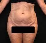 Mini Tummy Tuck - Case Case 6 - Before