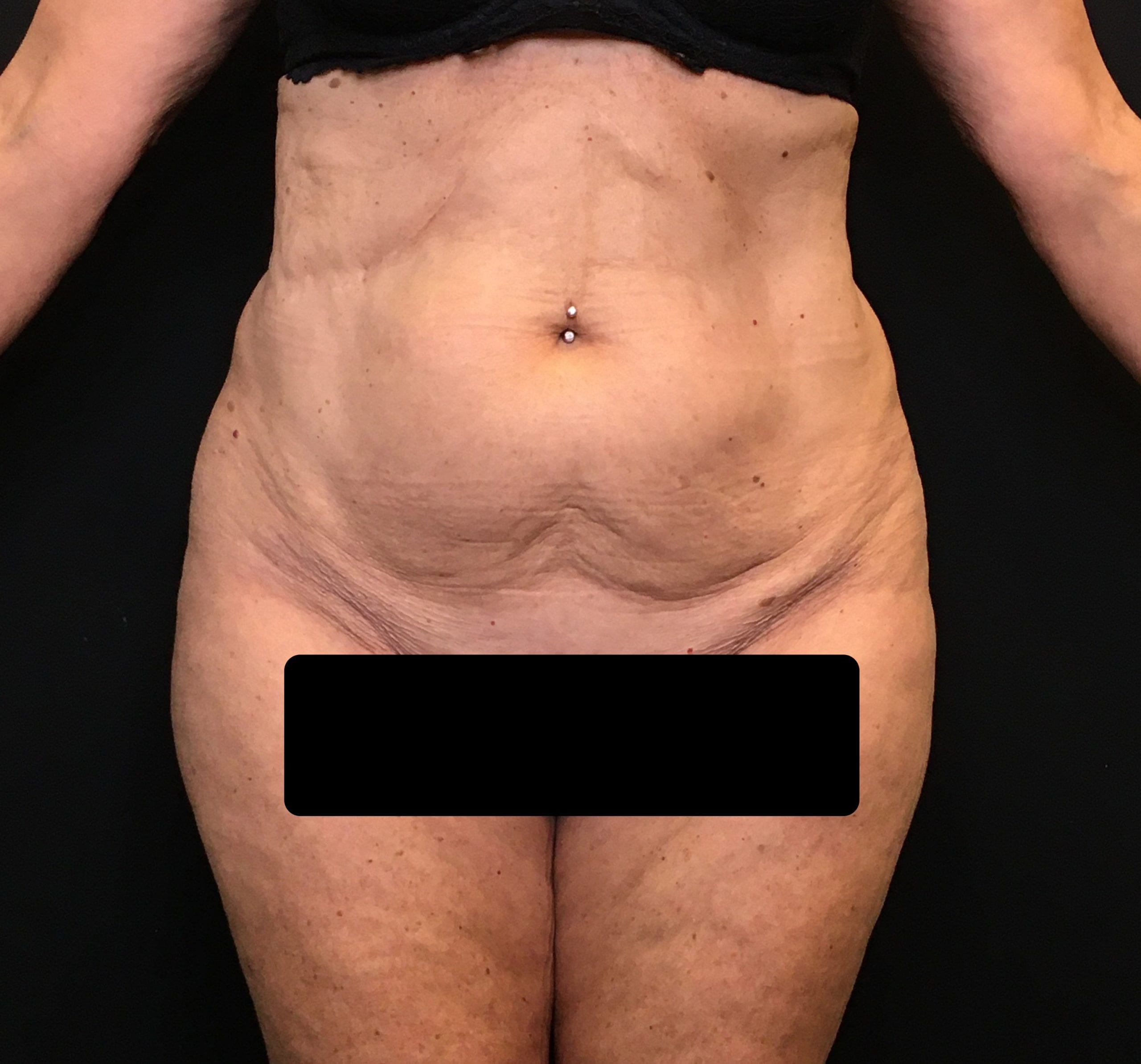 Mini Tummy Tuck Patient Photo - Case Case 6 - before view-0