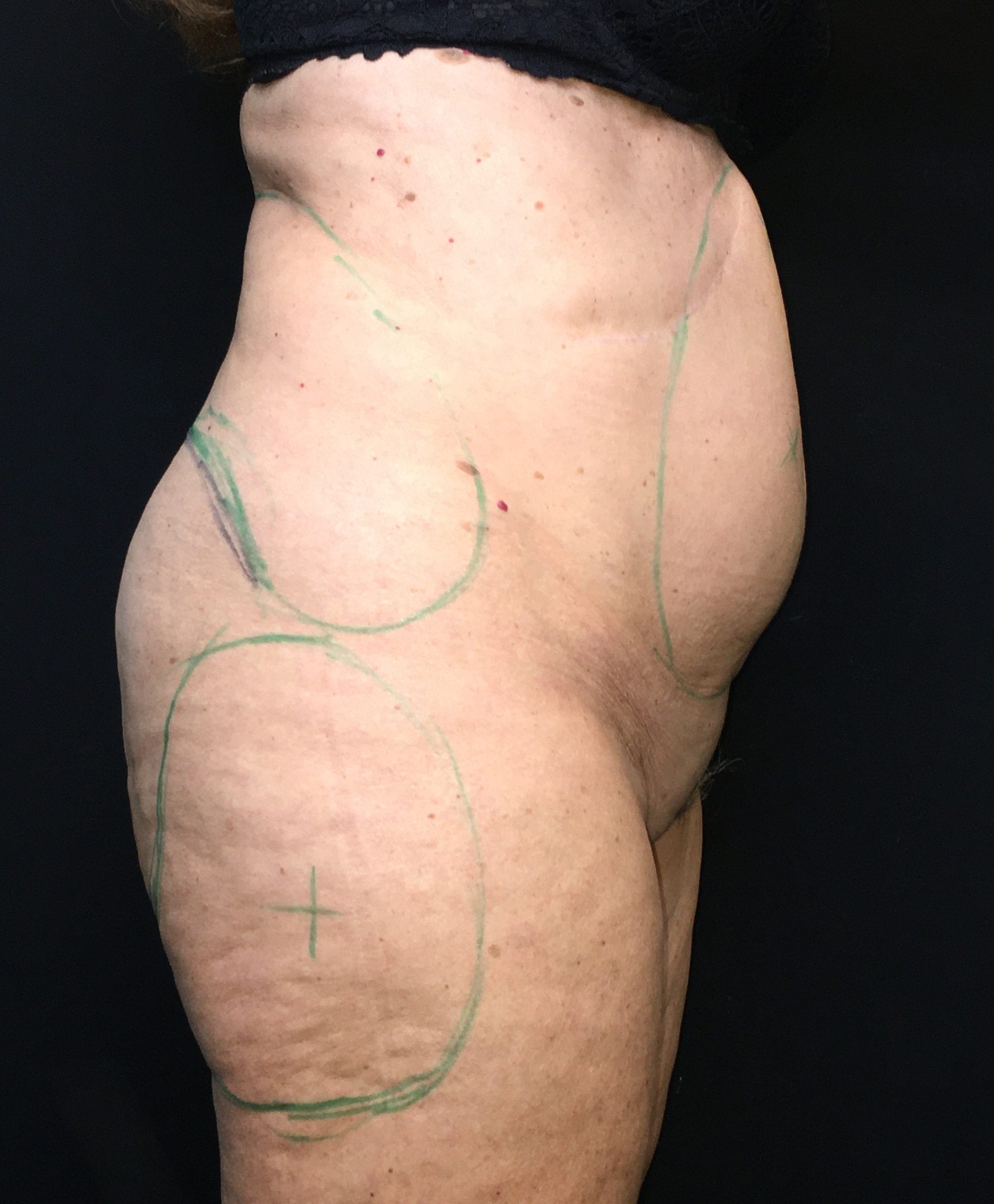 Mini Tummy Tuck Patient Photo - Case Case 6 - before view-1