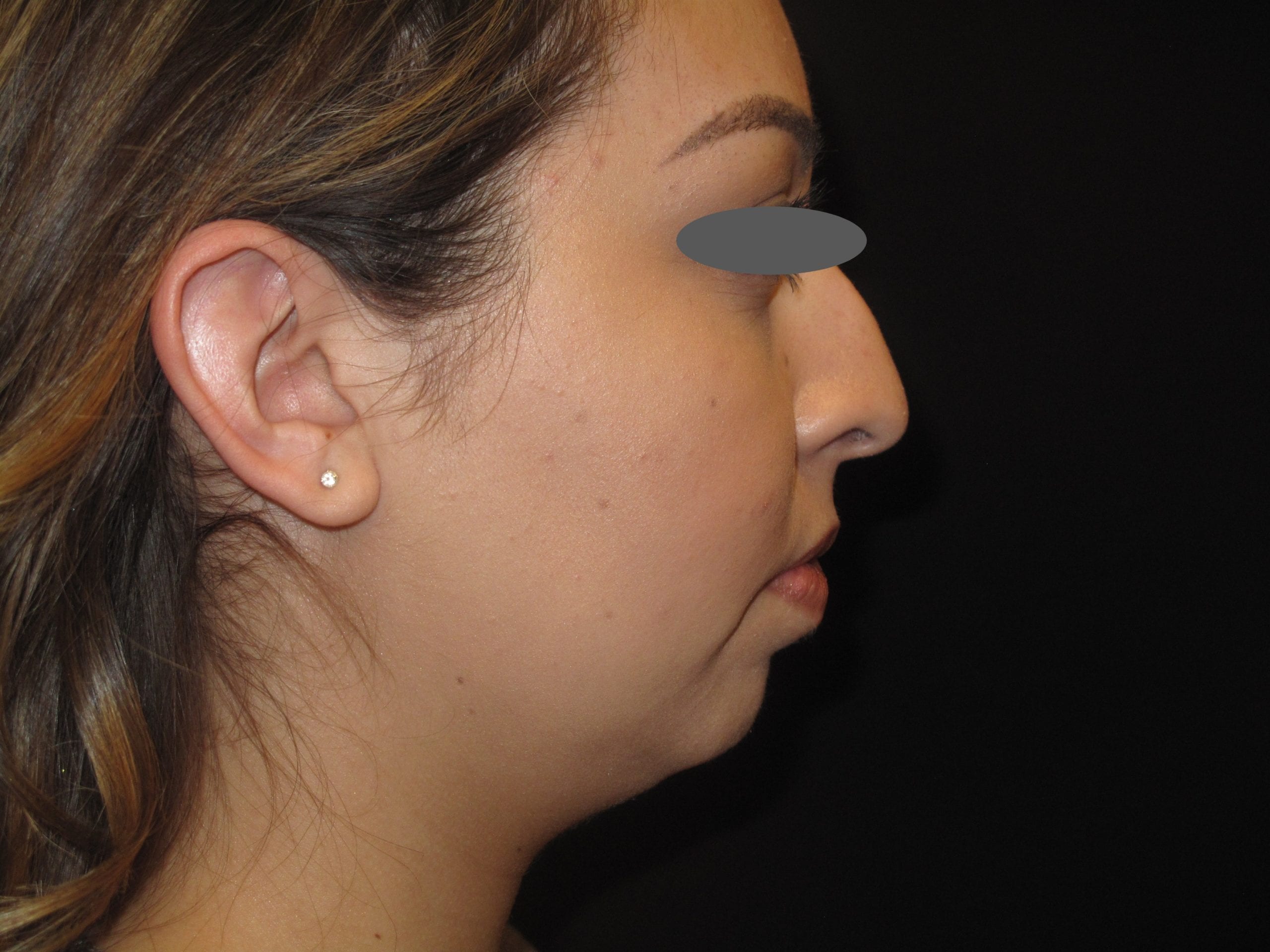 Chin Implant Patient Photo - Case Case 1 - before view-1