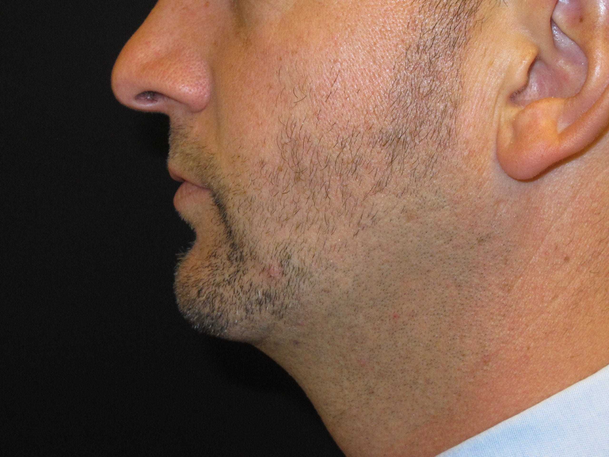 Chin Implant Patient Photo - Case Case 2 - after view-1