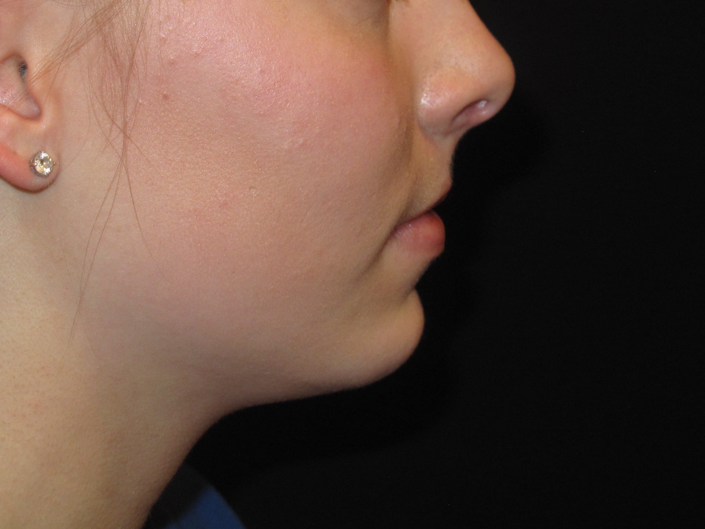 Chin Implant Patient Photo - Case Case 3 - after view-1