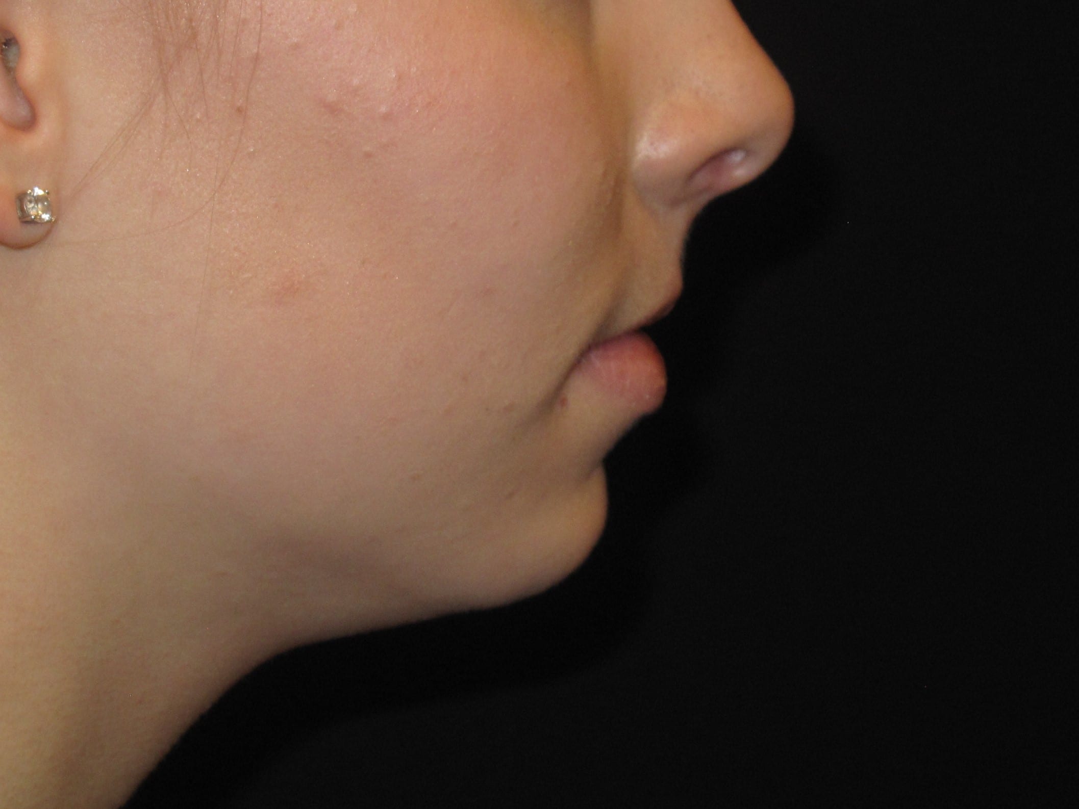 Chin Implant Patient Photo - Case Case 3 - before view-1