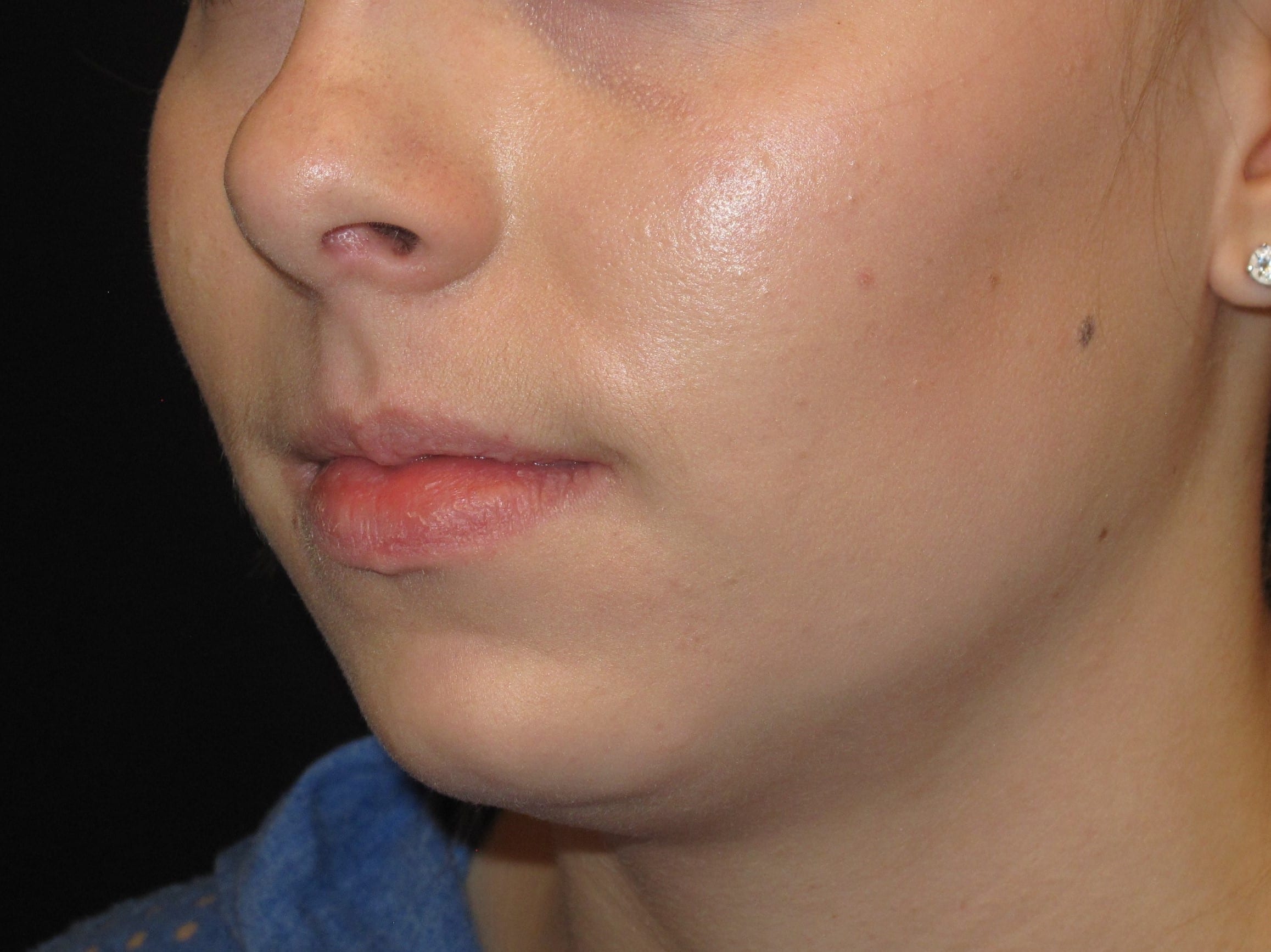Chin Implant Patient Photo - Case Case 3 - before view-