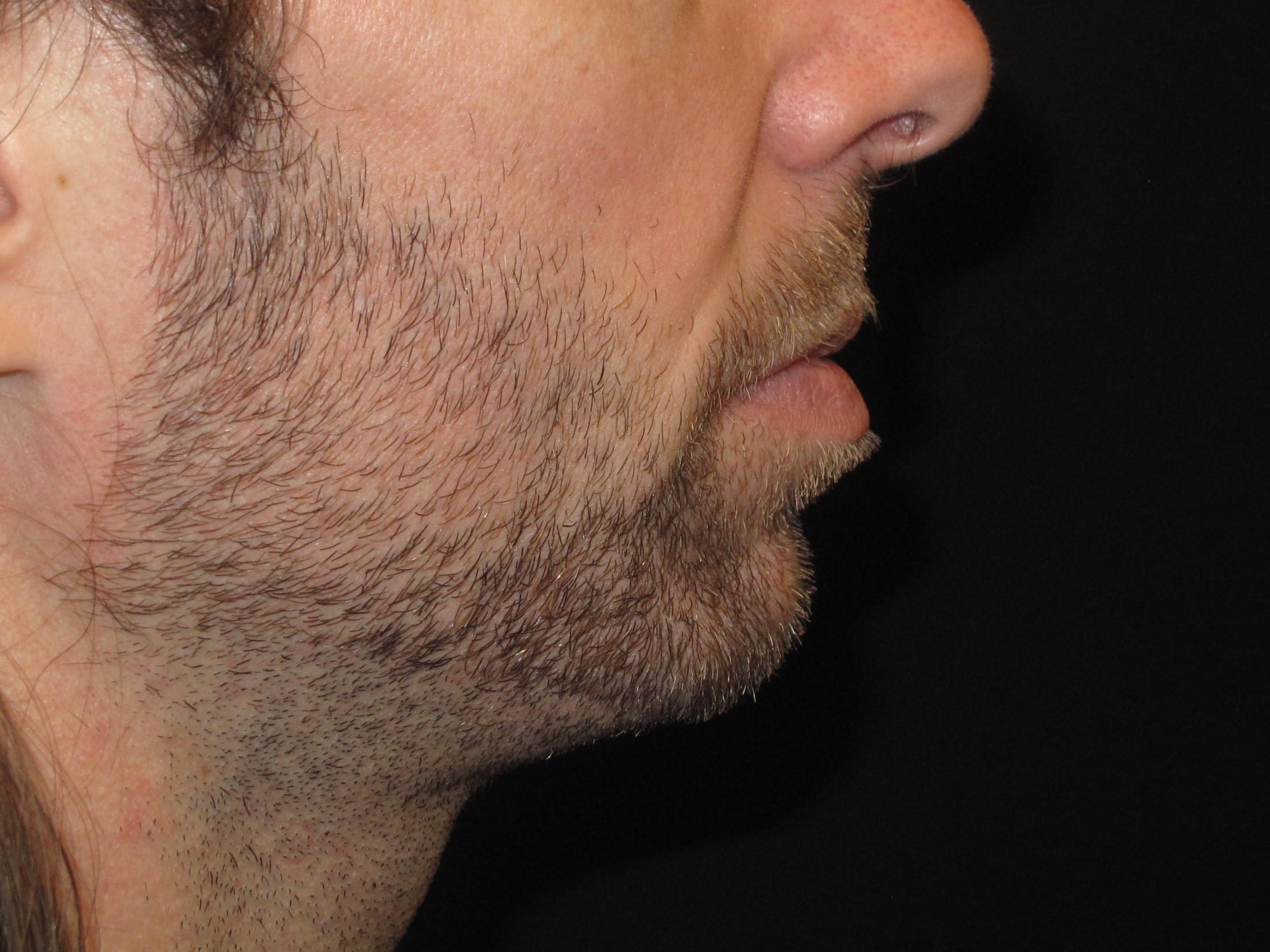 Chin Implant Patient Photo - Case Case 6 - before view-1